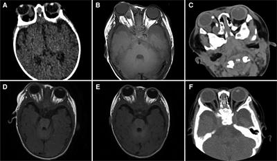 Infantile orbital abscess caused by methicillin-resistant Staphylococcus aureus: a case report and literature review